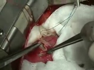 surgery to remove echinococcus from the heart